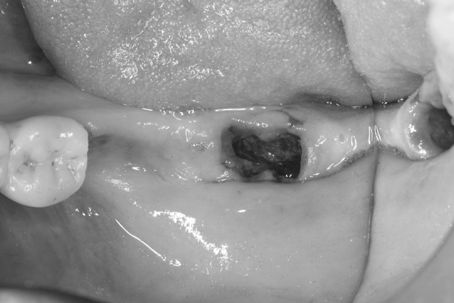 抜歯直後症例写真