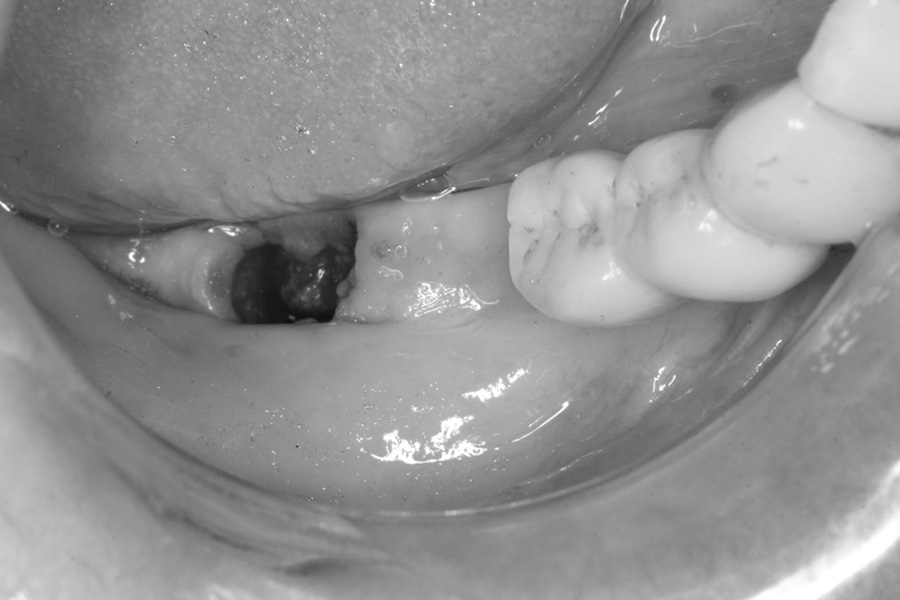 抜歯直後症例写真