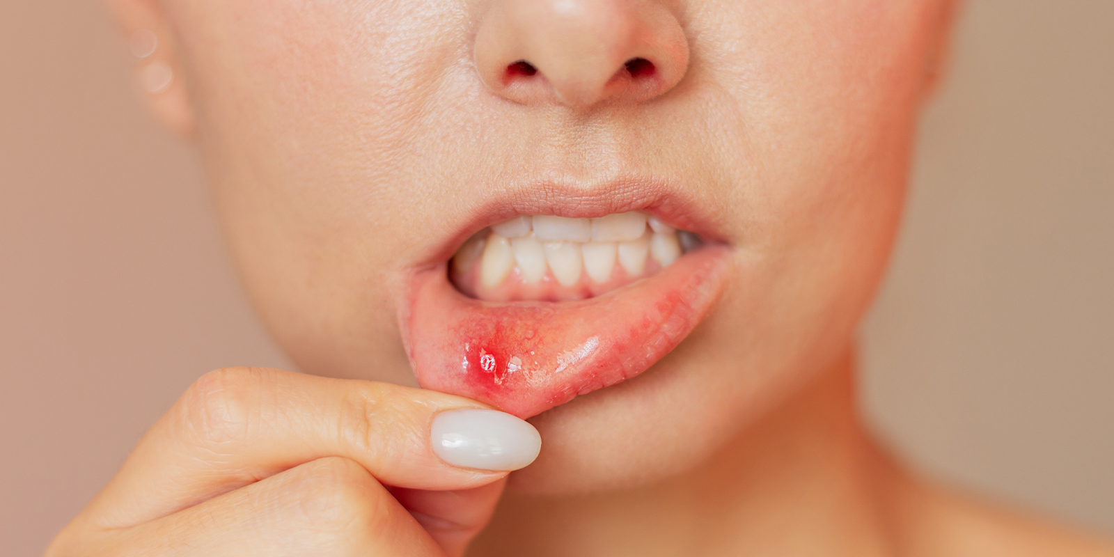 口内炎について